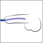 Silikon Dilator 3er Set 